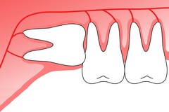 Что происходит во рту после удаления зуба?